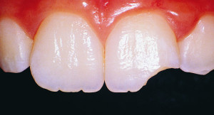 broken-chipped-tooth