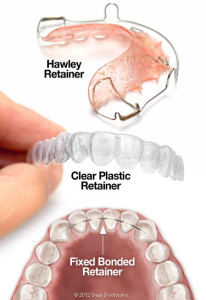 types-of-orthodontic-retainers