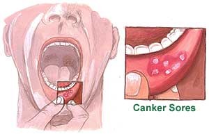 canker-sores-picture